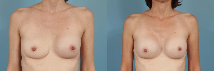 Before & After Breast Implant Replacement Case 193 View #1 View in Chicago, IL