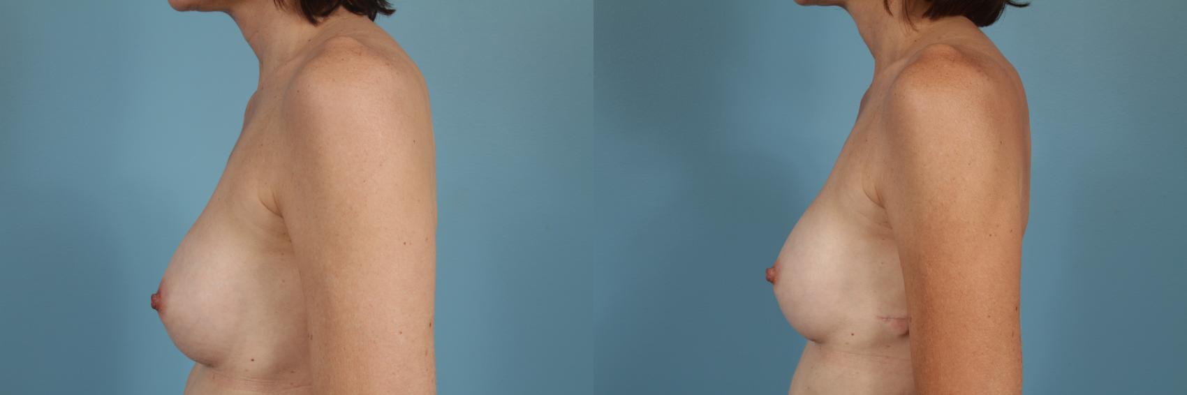 Before & After Breast Implant Replacement Case 193 View #2 View in Chicago, IL