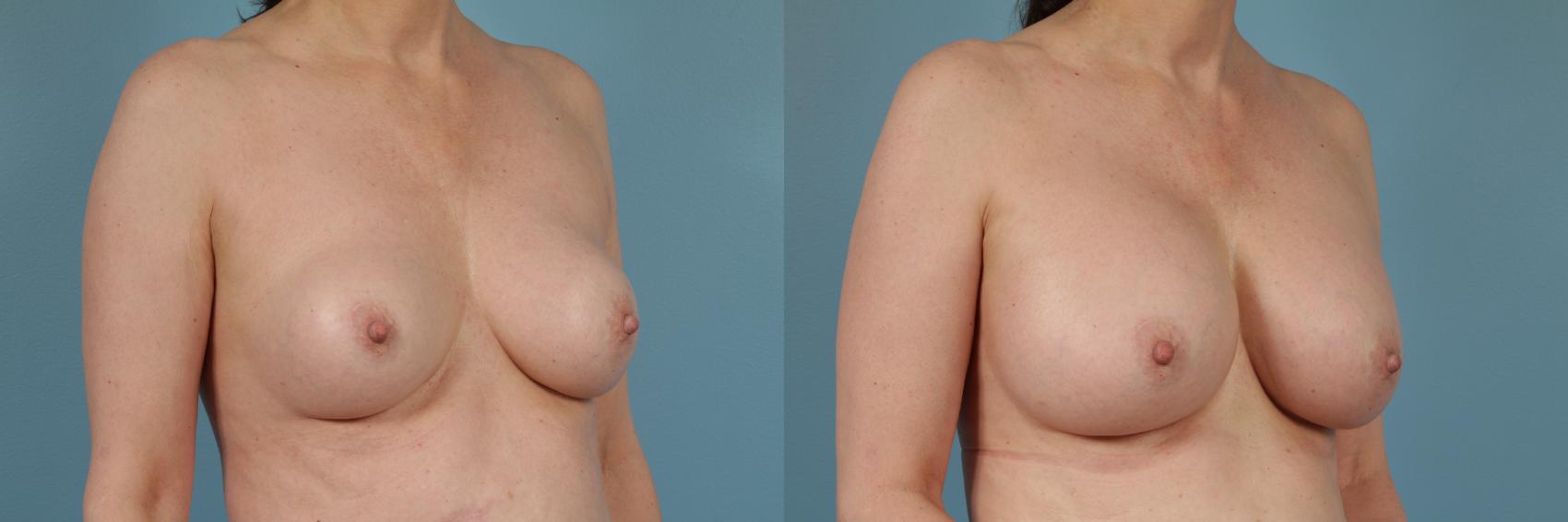 Before & After Breast Implant Replacement Case 235 View #2 View in Chicago, IL