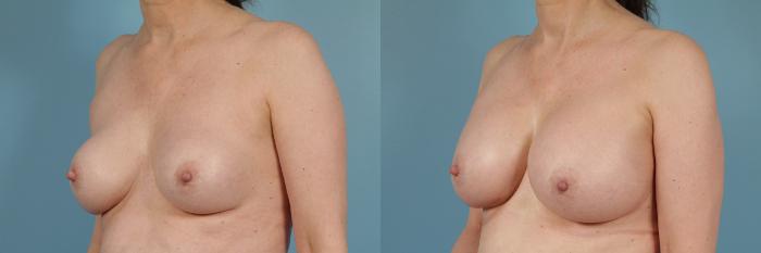 Before & After Breast Implant Replacement Case 235 View #3 View in Chicago, IL