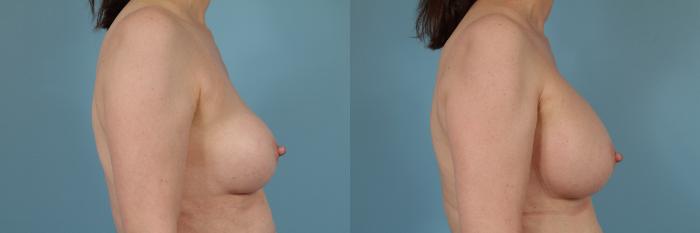 Before & After Breast Implant Replacement Case 235 View #4 View in Chicago, IL