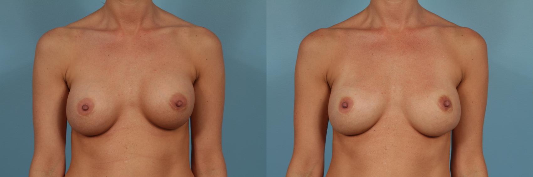 Before & After Breast Implant Replacement Case 245 View #1 View in Chicago, IL