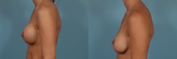 Before & After Breast Implant Replacement Case 245 View #2 View in Chicago, IL