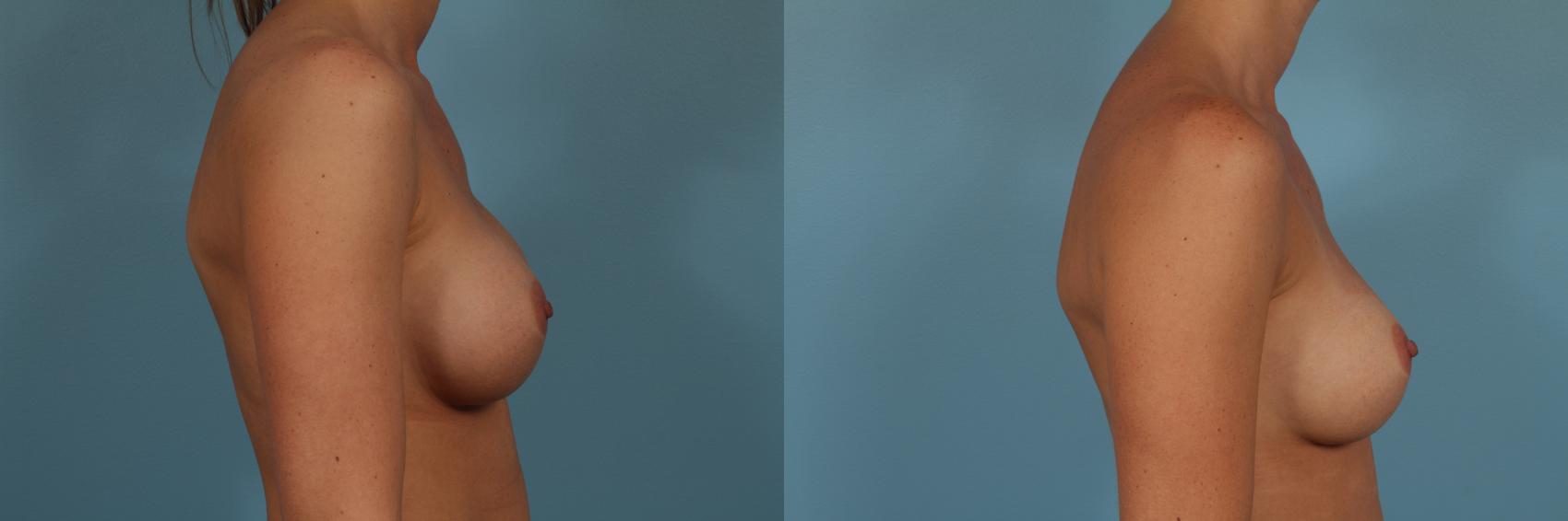 Before & After Breast Implant Replacement Case 245 View #3 View in Chicago, IL