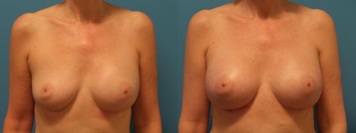 Before & After Breast Implant Replacement Case 388 View #1 View in Chicago, IL