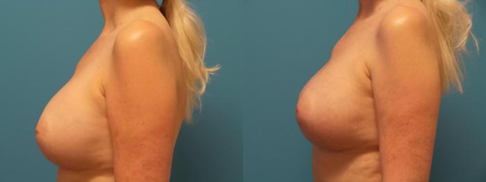 Before & After Breast Implant Replacement Case 388 View #2 View in Chicago, IL