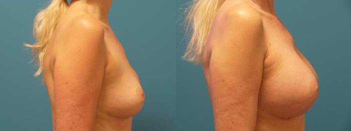 Before & After Breast Implant Replacement Case 388 View #3 View in Chicago, IL