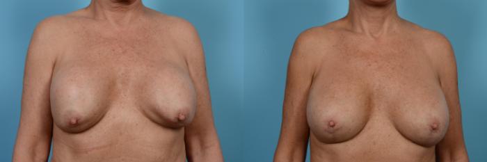 Before & After Breast Implant Replacement Case 484 View #1 View in Chicago, IL