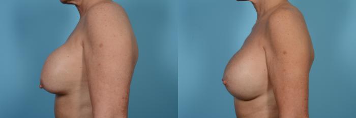 Before & After Breast Implant Replacement Case 484 View #2 View in Chicago, IL