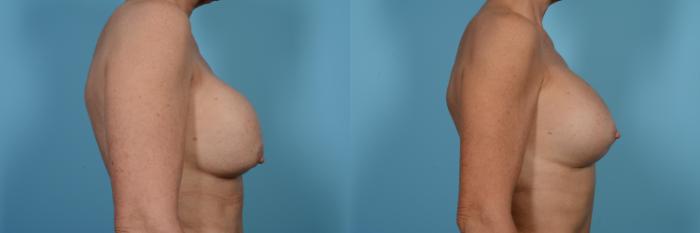 Before & After Breast Implant Replacement Case 484 View #3 View in Chicago, IL