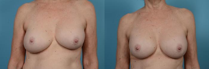 Before & After Breast Implant Replacement Case 515 View #1 View in Chicago, IL