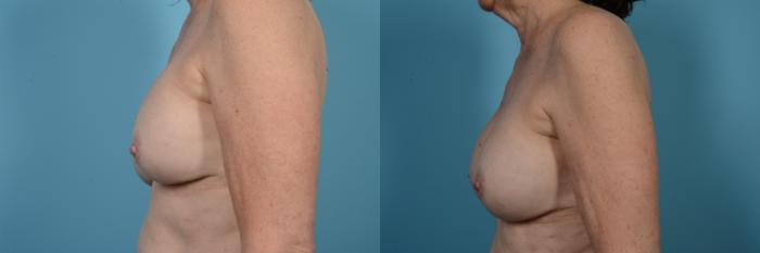 Before & After Breast Implant Replacement Case 515 View #2 View in Chicago, IL