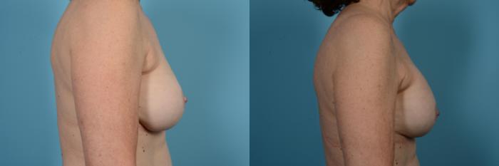 Before & After Breast Implant Replacement Case 515 View #3 View in Chicago, IL