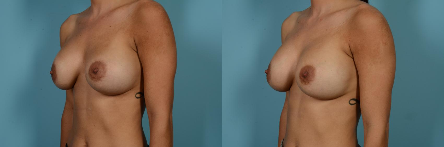 Dr. Sinno Implant Replacement in Chicago, Illinois