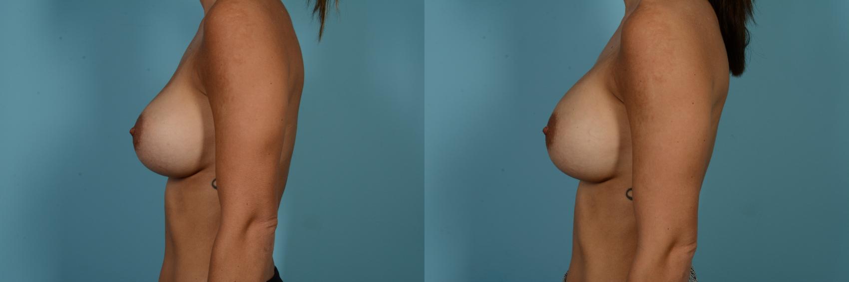 Dr. Sinno Implant Replacement in Chicago, Illinois