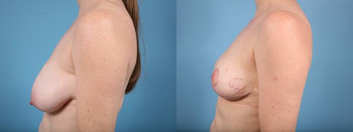 Before & After Breast Lift Case 10 View #2 View in Chicago, IL