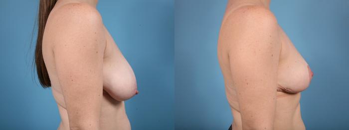 Before & After Breast Lift Case 10 View #3 View in Chicago, IL