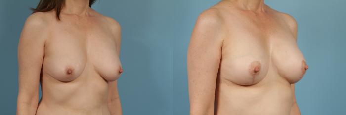 Before & After Breast Lift Case 248 View #3 View in Chicago, IL