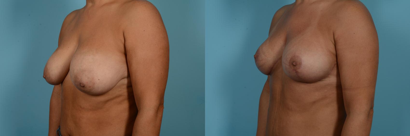 Dr. Sinno Mastopexy in Chicago, Illinois