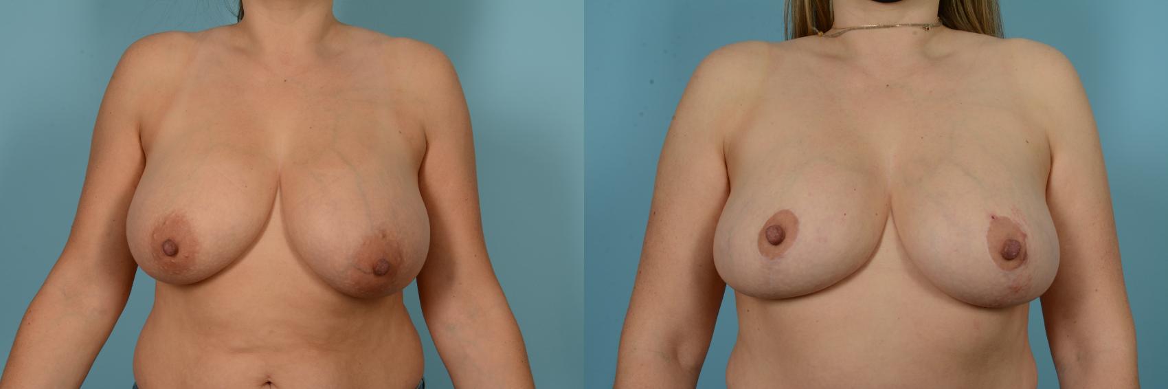 Before & After Breast Lift Case 776 Front View in Chicago, IL