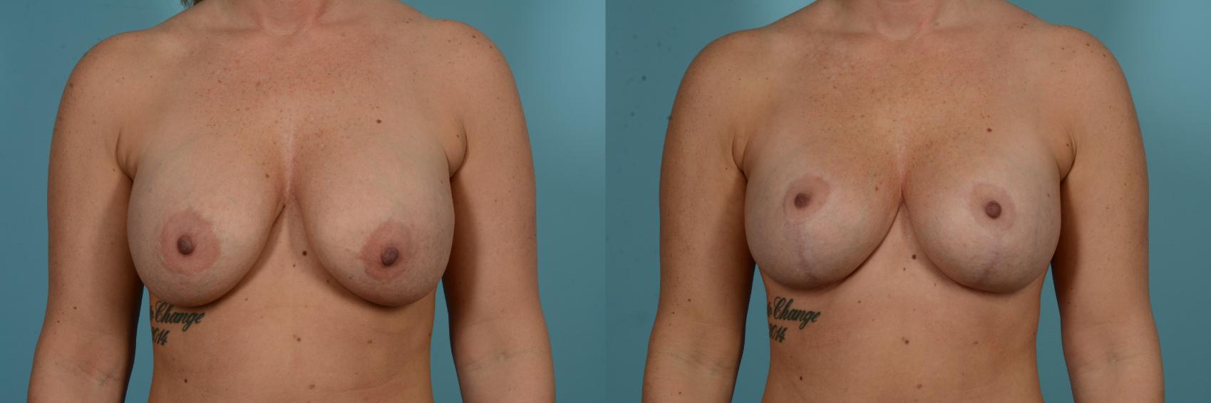 Before & After Breast Lift Case 899 Front View in Chicago, IL