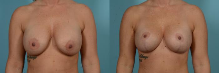 Before & After Breast Implant Replacement Case 899 Front View in Chicago, IL