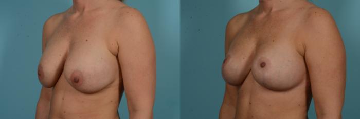 Before & After Breast Implant Replacement Case 899 Left Oblique View in Chicago, IL