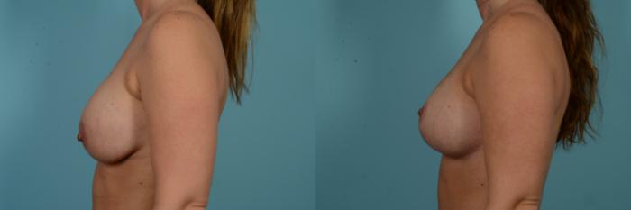 Before & After Breast Lift Case 899 Left Side View in Chicago, IL