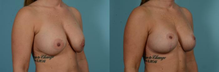 Before & After Breast Lift Case 899 Right Oblique View in Chicago, IL