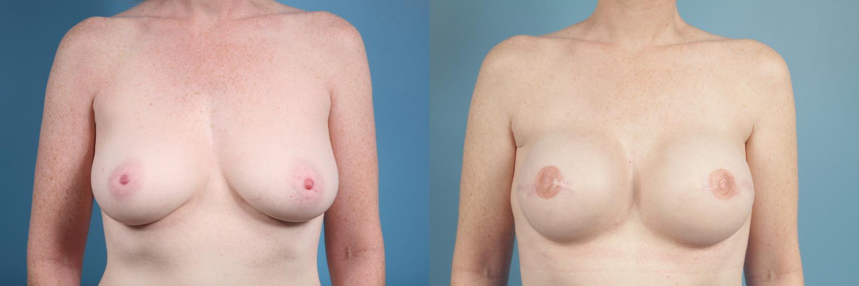 Before & After Breast Reconstruction Case 109 View #1 View in Chicago, IL
