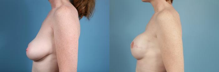Before & After Breast Reconstruction Case 109 View #2 View in Chicago, IL