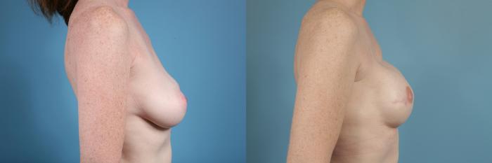 Before & After Breast Reconstruction Case 109 View #3 View in Chicago, IL