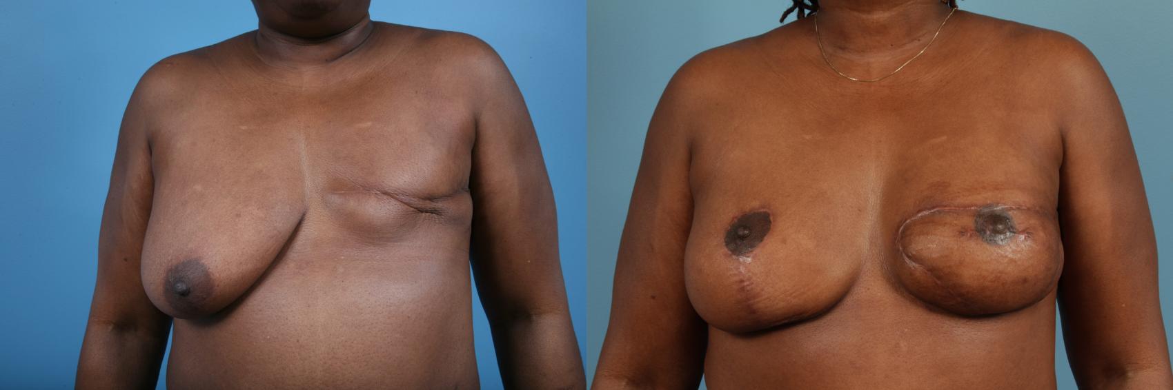 Before & After Breast Reconstruction Case 119 View #2 View in Chicago, IL