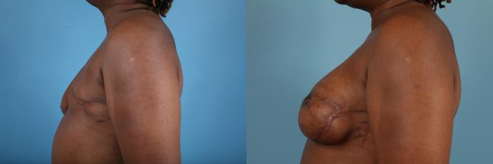 Before & After Breast Reconstruction Case 119 View #3 View in Chicago, IL