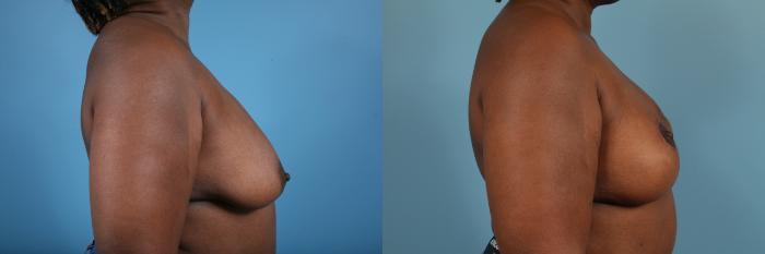 Before & After Breast Reconstruction Case 119 View #4 View in Chicago, IL