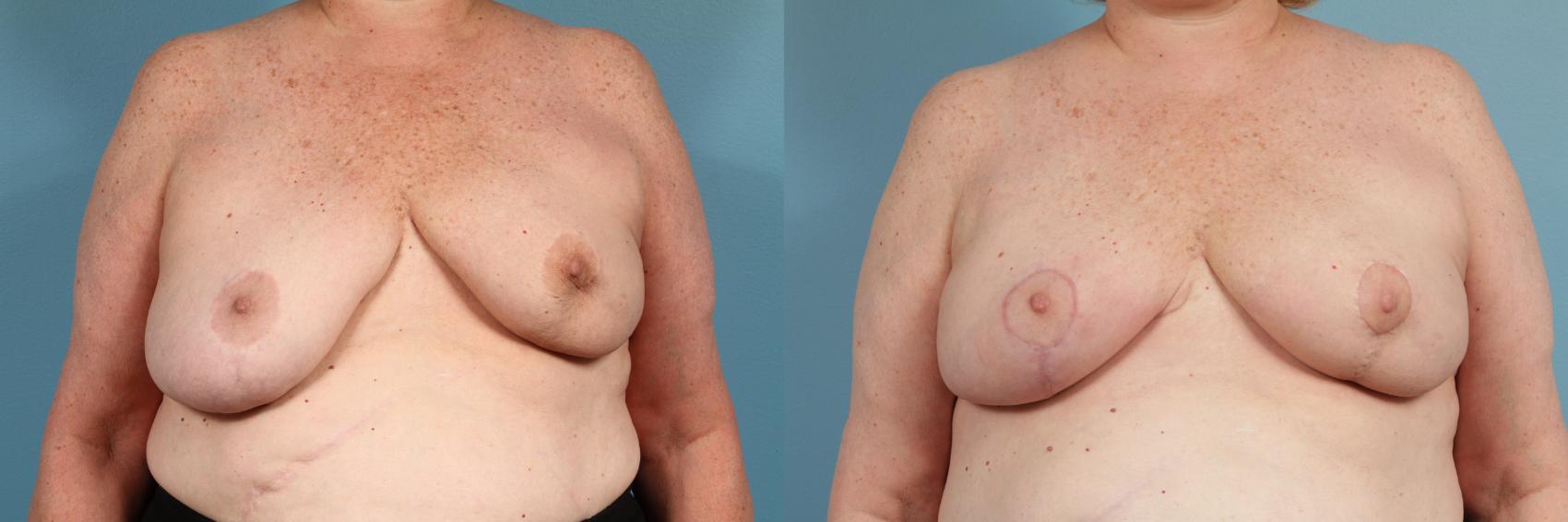 Before & After Breast Reconstruction Case 121 View #1 View in Chicago, IL