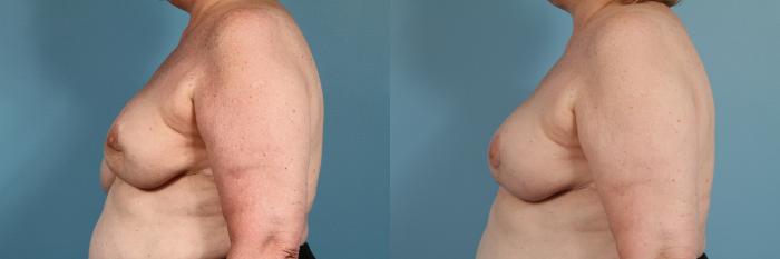 Before & After Breast Reconstruction Case 121 View #2 View in Chicago, IL