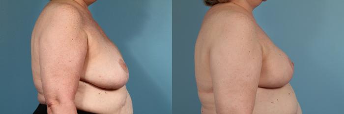 Before & After Breast Reconstruction Case 121 View #3 View in Chicago, IL