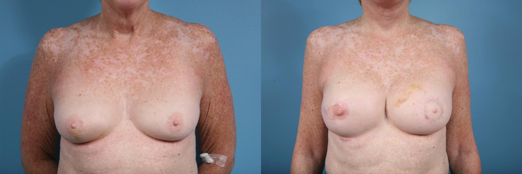 Before & After Breast Reconstruction Case 122 View #1 View in Chicago, IL