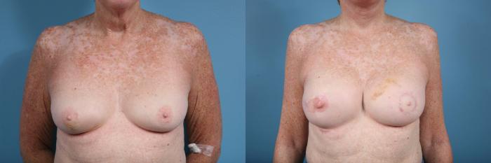 Before & After Breast Reconstruction Case 122 View #1 View in Chicago, IL