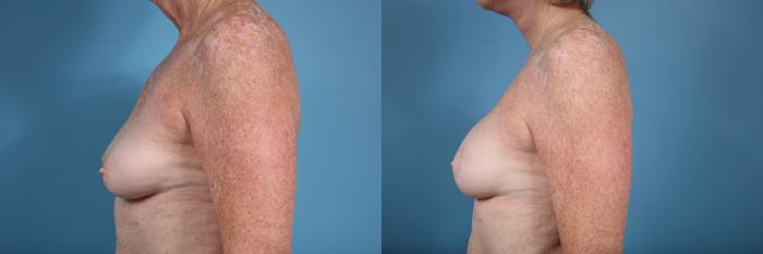 Before & After Breast Reconstruction Case 122 View #2 View in Chicago, IL