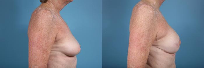 Before & After Breast Reconstruction Case 122 View #3 View in Chicago, IL