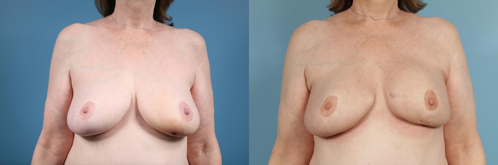 Before & After Breast Reconstruction Case 136 View #1 View in Chicago, IL