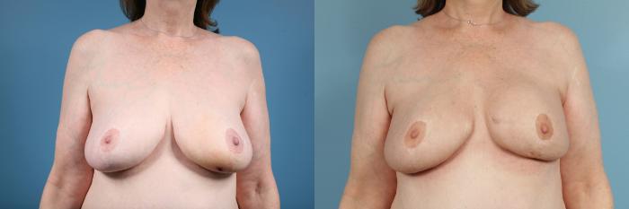 Before & After Breast Reconstruction Case 136 View #1 View in Chicago, IL