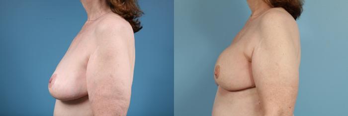 Before & After Breast Reconstruction Case 136 View #2 View in Chicago, IL