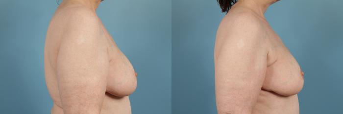 Before & After Breast Reconstruction Case 136 View #3 View in Chicago, IL