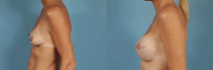 Before & After Breast Reconstruction Case 188 View #2 View in Chicago, IL