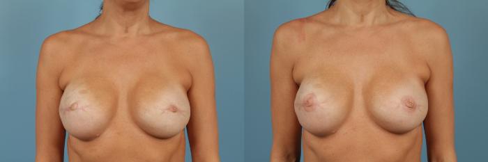 Before & After Breast Reconstruction Case 208 View #2 View in Chicago, IL