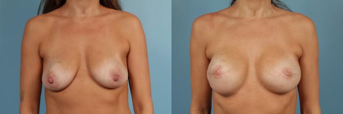 Before & After Breast Reconstruction Case 208 View #3 View in Chicago, IL