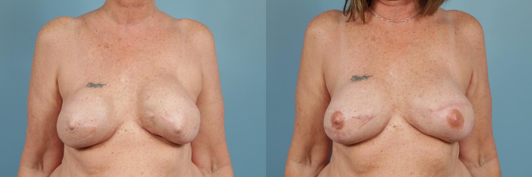 Before & After Breast Reconstruction Case 210 View #1 View in Chicago, IL